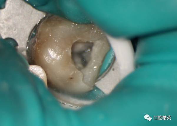 上颌第二磨牙根管口图图片
