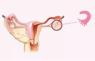 输卵管通液过程图图片