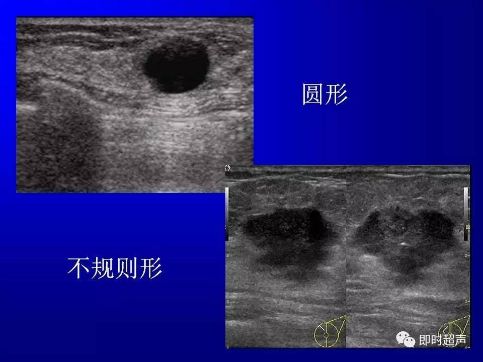 正常乳腺超声图像图片