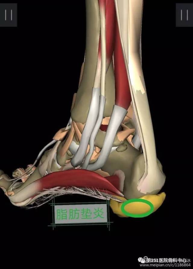 常見足跟痛疾病的診斷與治療要點