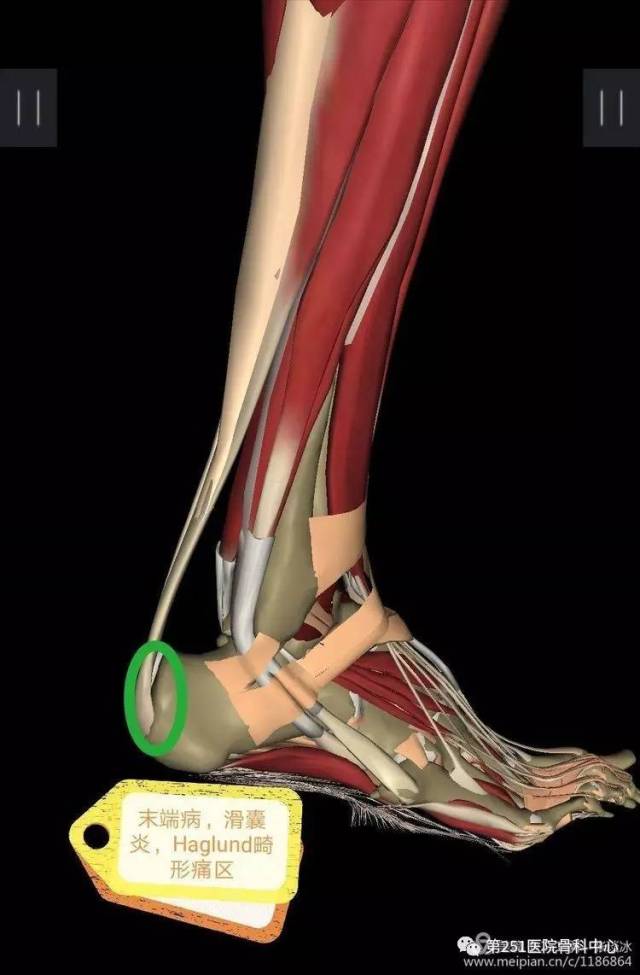 足跟腱鞘炎的位置图图片