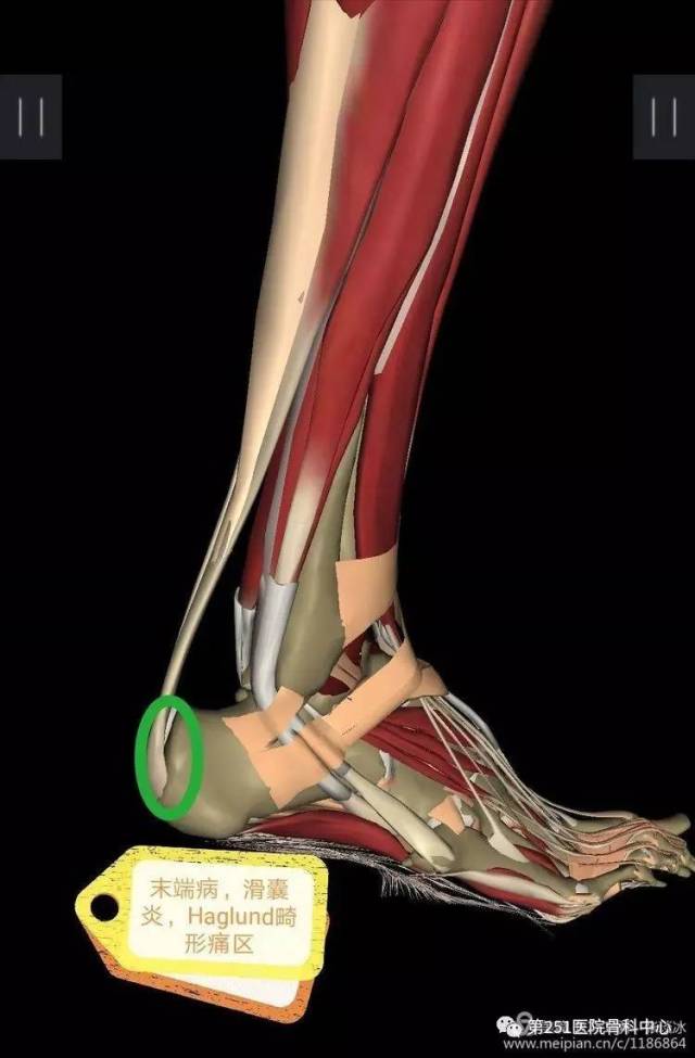 haglund病和跟腱末端病五跟腱末端病,滑囊炎,haglund病你能分清嗎?