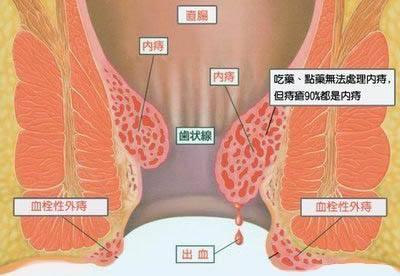 男人外痔疮图片初期图片