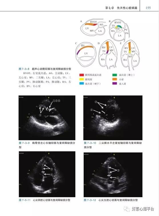 《心超笔记》(第一辑)共8 章,分别从超声心动图基础,心功能,心脏超声