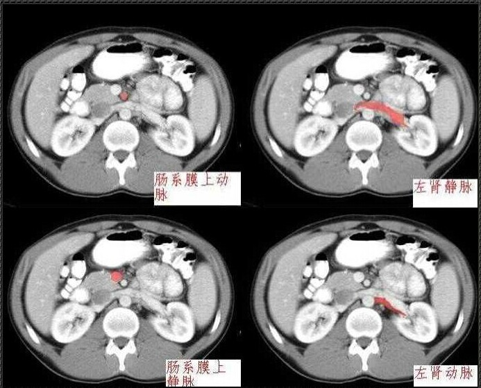 十分钟学会腹部ct解剖多图