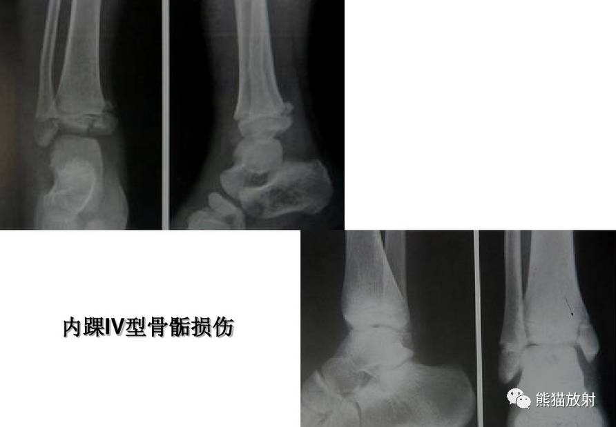 发生在骨骺(生长板)约18-30%的儿童骨折累及骨骺骨骺损伤多见于青少年