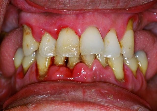 一般情况下,牙龈出血常见于牙周炎的早期——牙龈炎