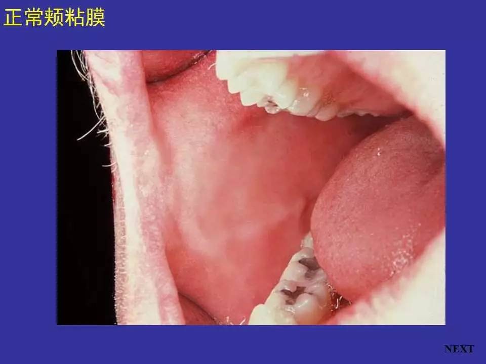 口腔粘膜正常图片