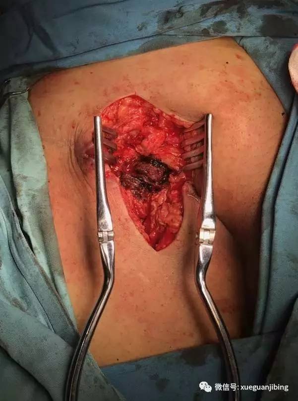 可以看到穿刺点是在股浅动脉)回顾这例患者,考虑穿刺后出现假性动脉瘤