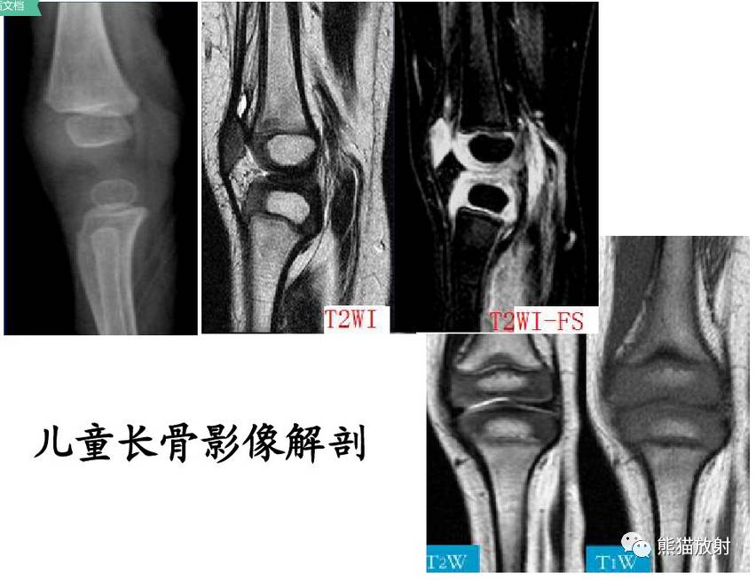 發生在骨骺(生長板)約18-30%的兒童骨折累及骨骺骨骺損傷多見於青少年