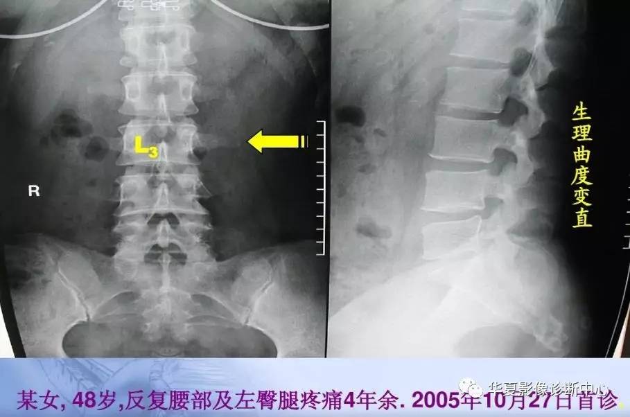 第三腰椎横突位置图图片