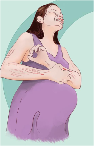 孕妇胆汁淤积图片