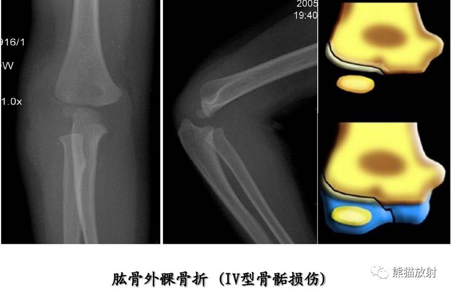 发生在骨骺(生长板)约18-30%的儿童骨折累及骨骺骨骺损伤多见于青少年