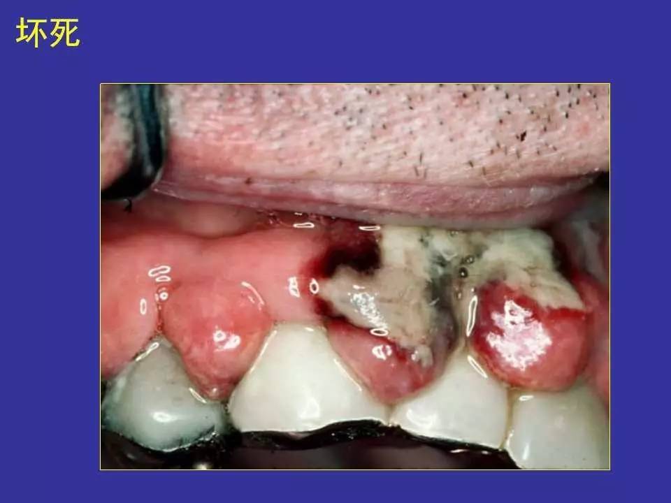 萎缩:黏膜和结缔组织的体积缩小和数目减少萎缩性舌炎,干燥综合征10