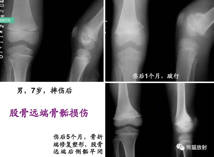 发生在骨骺(生长板)约18-30%的儿童骨折累及骨骺骨骺损伤多见于青少年