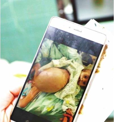新生儿巨结肠图片图片