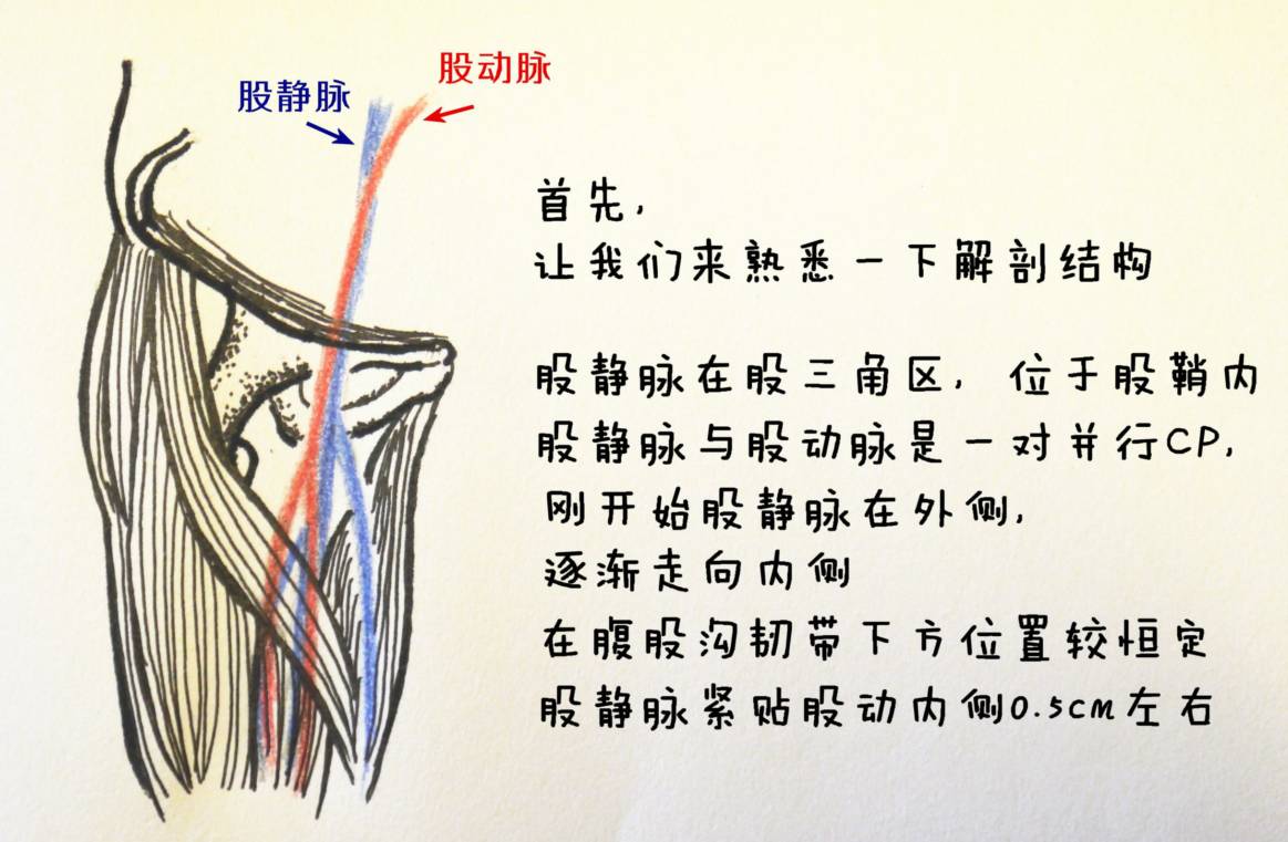 股静脉置管示意图图片