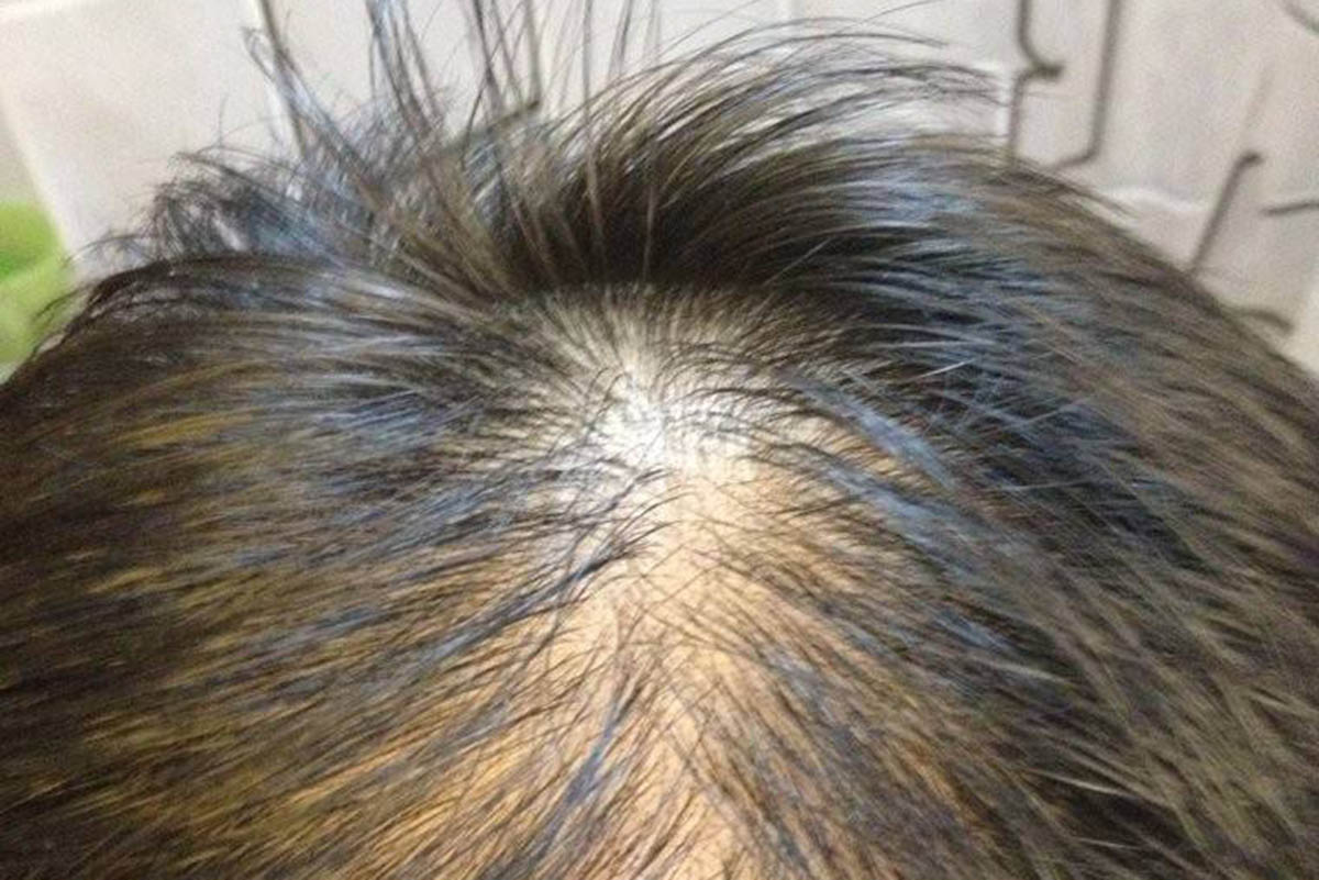 病理性脱发是指头发异常或过度的脱落,其原因很多