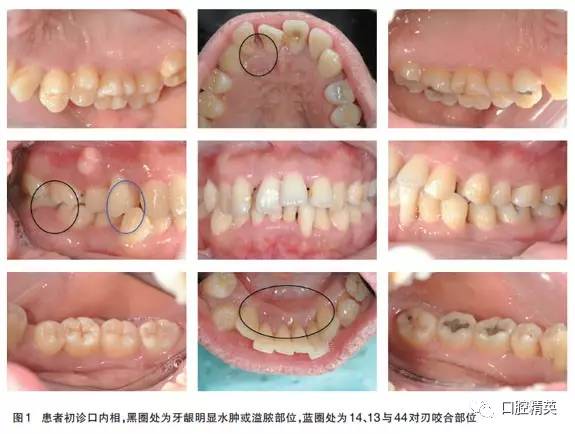 无明显龈上牙石,菌斑软垢也较少;②患者有广泛的深牙周袋