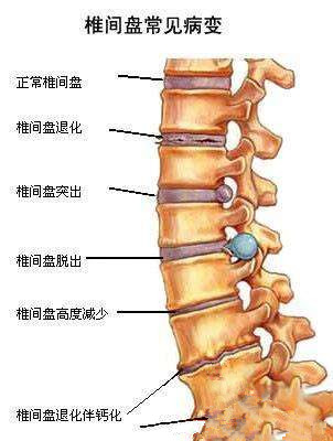 患者于两年前无明显诱因出现腰痛伴左下肢放射性疼痛,当地诊断为腰椎