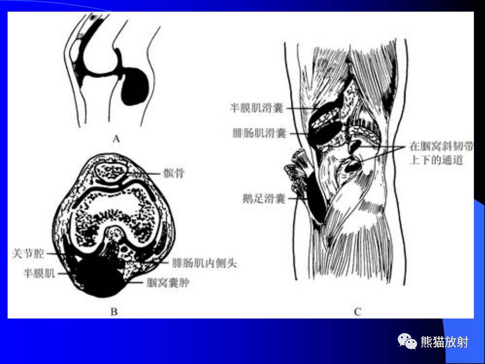 專家講座膝關節周圍囊腫mri表現林祥濤