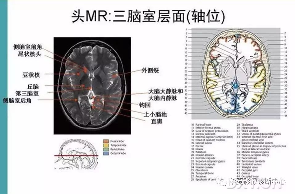 完整的頭顱mri解剖值得收藏