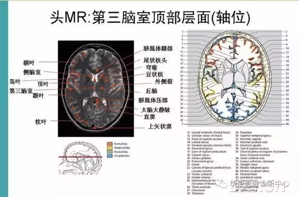 完整的頭顱mri解剖值得收藏