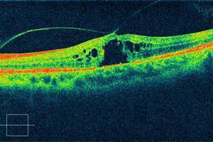 视力下降视物变形当心不是眼花而是黄斑裂孔
