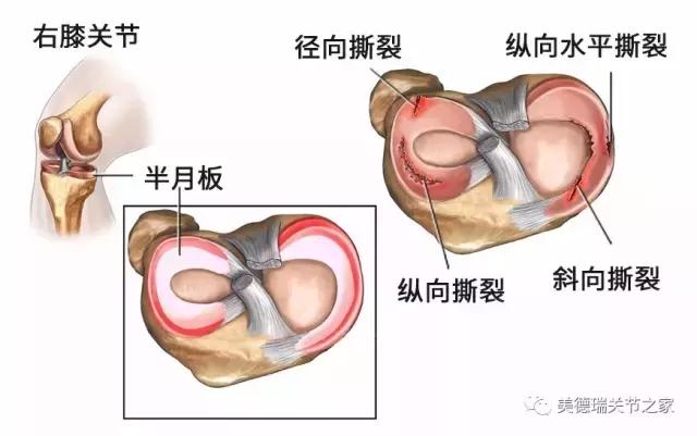 半月板撕裂症状图片