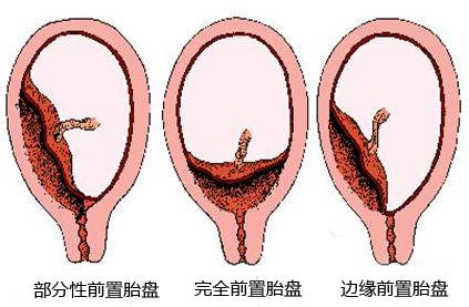 胎盤正常附著子宮的前壁,後壁或者側壁,但是如果胎盤附著的是子宮口處