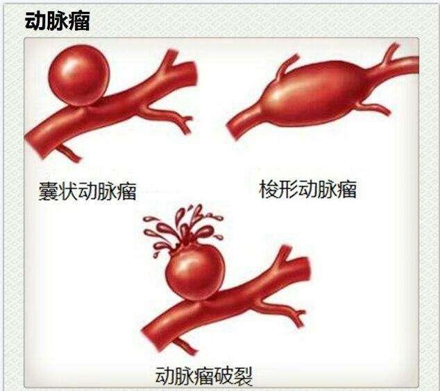 腦動脈瘤是腫瘤嗎?萬一出血死亡率近1/3,你卻對它一無所知!