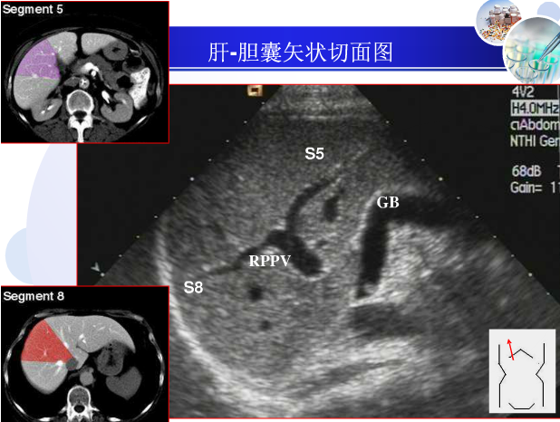 【超声微课堂】肝脏超声分段