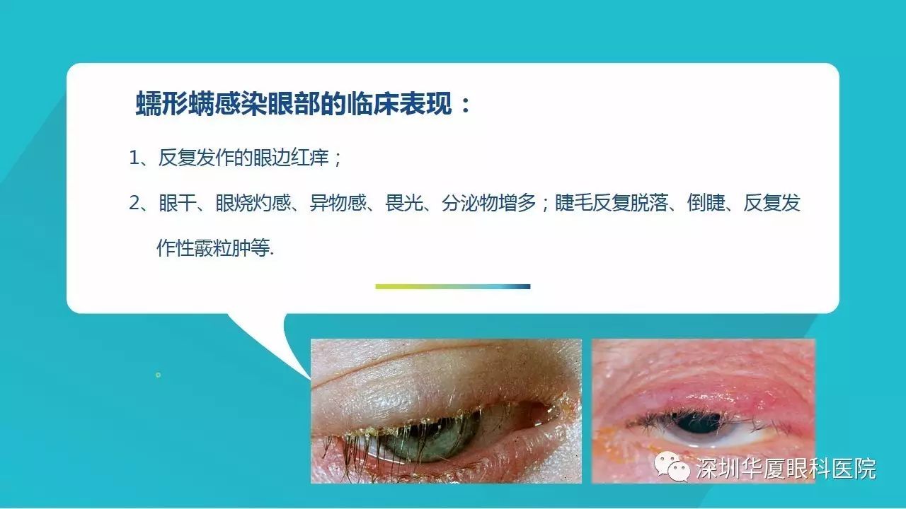 干眼的有一病因现行螨虫