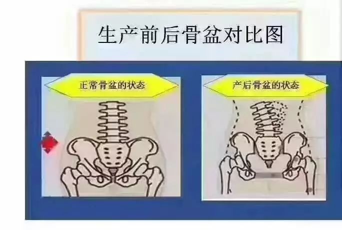 有的媽媽會說,我是剖腹產,沒開骨縫,不需要