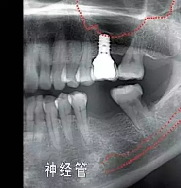 因手术损伤这些重要结构,医院会要求您手术前拍摄3d x光片作为参考