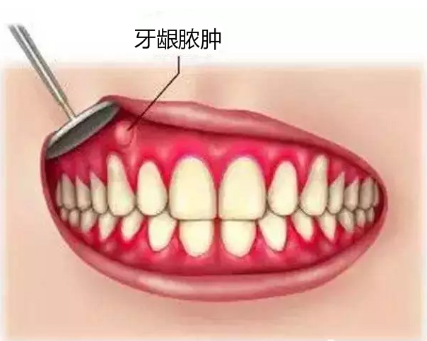 牙龈肿胀怎么解决图片