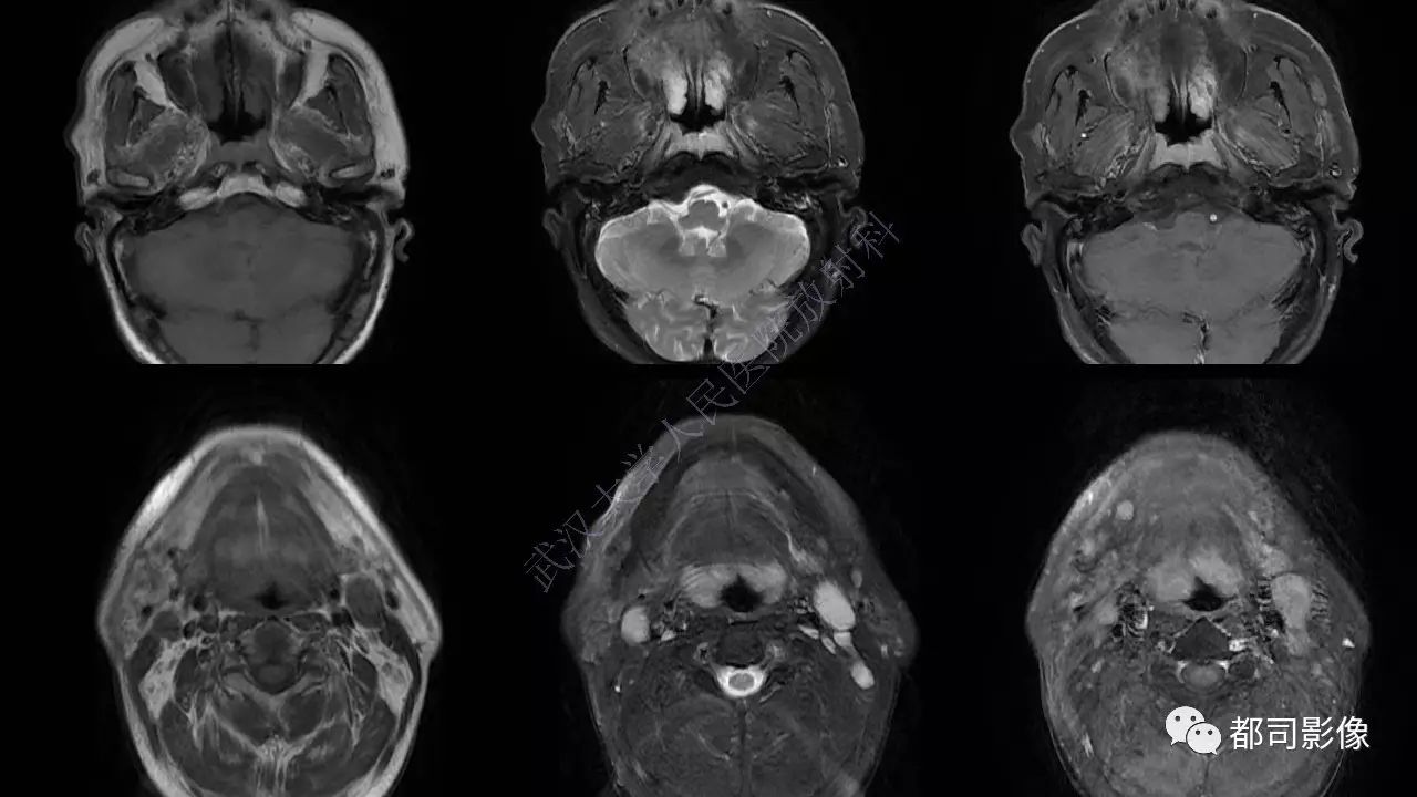 鼻咽腫瘤性病變影像診斷