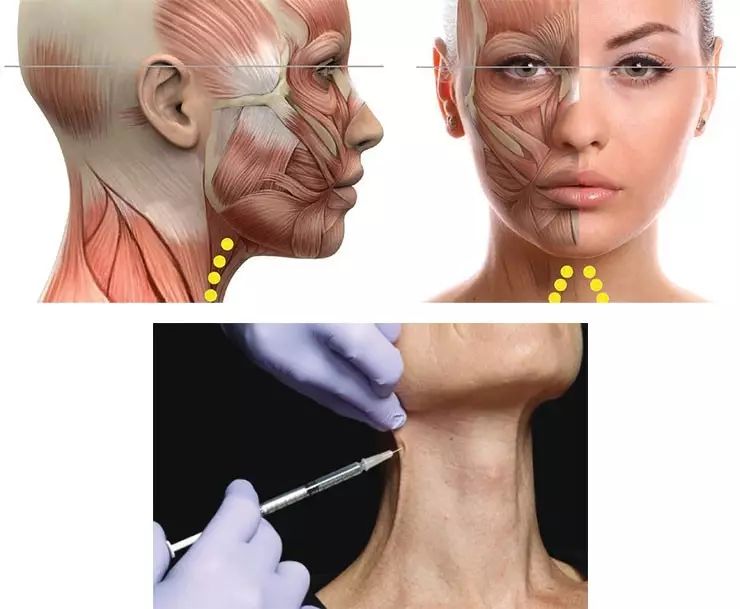 注射a型肉毒毒素改善颈阔肌束,每侧侧面颈阔肌束注射4点,每侧中央颈
