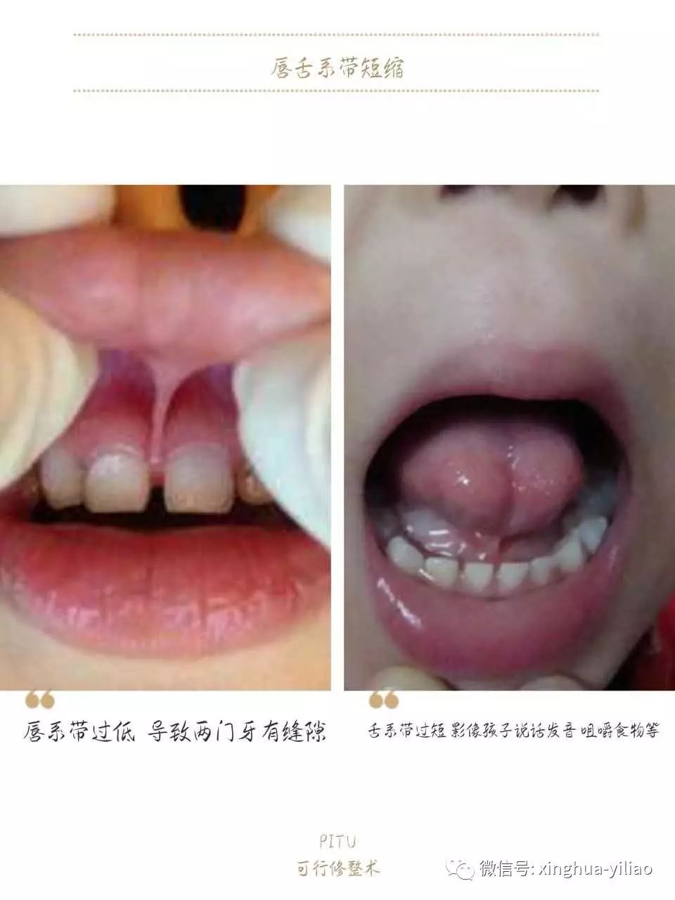 兴华口腔诊疗中心舌系带手术最佳治疗时间:1岁半—2岁龋齿鹅口疮