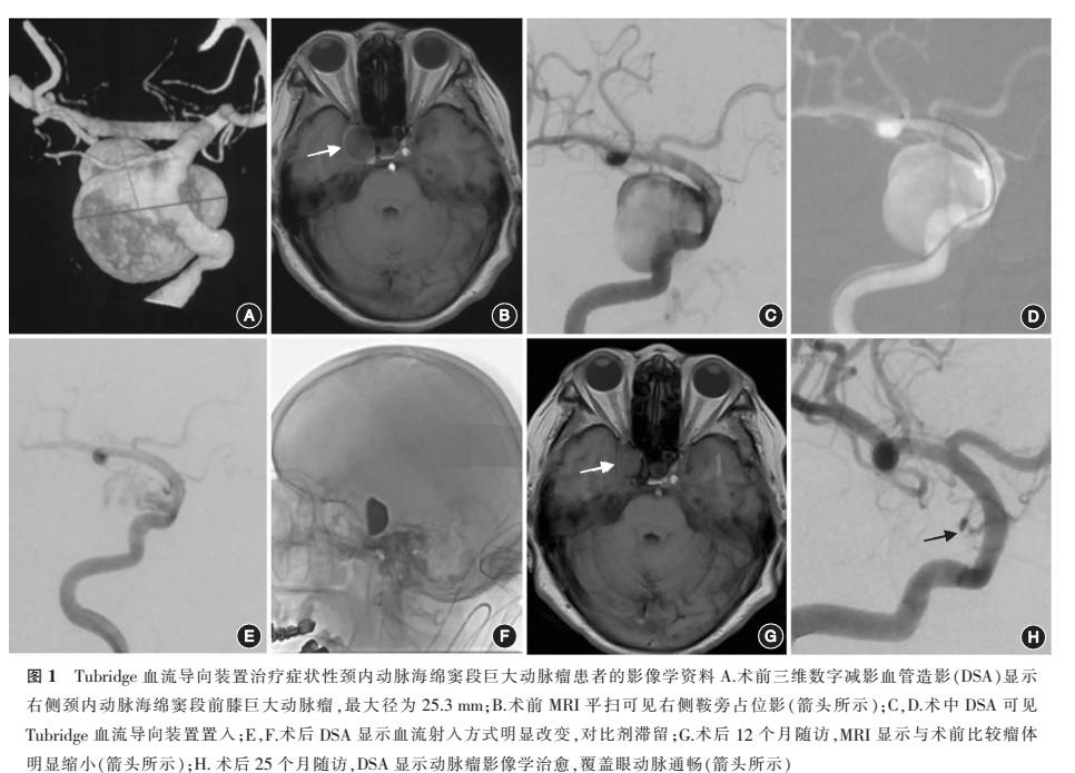 tubridge血流導向裝置治療大型和巨大型頸內動脈海綿竇段動脈瘤的長期