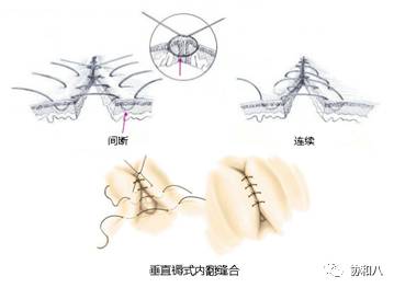 垂直褥式内翻缝合(vertical mattress inverting suture)缝合后组织