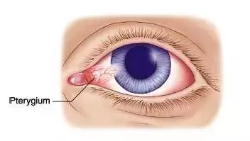 眼睛长小包块不可大意当心是翼状胬肉