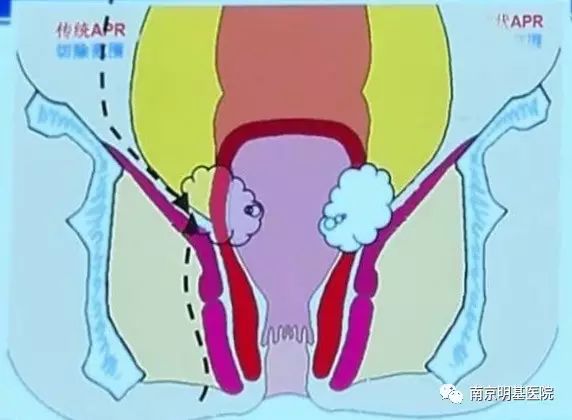 我院成功开展首例超低位直肠癌保肛手术