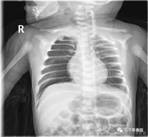 影像学表现:结合两张片观察,右下肺片状稍高密影,边界模糊,右肺野透光