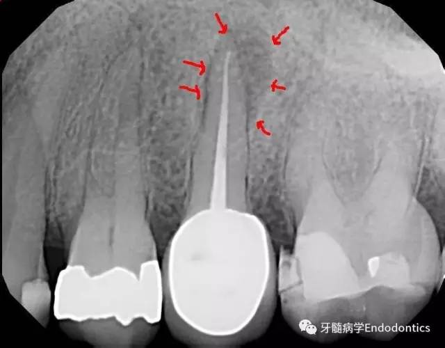 病例分享67根充短於根尖患牙能否癒合