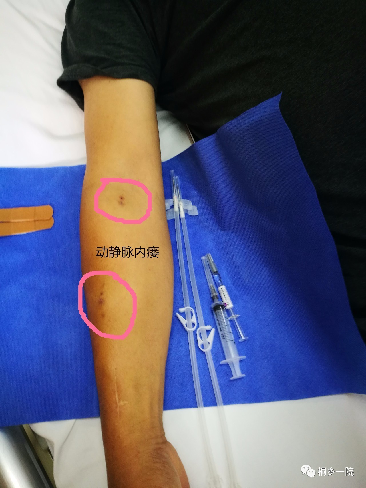正文答案来了,最左边那个巨大的针头,就是血透患者的专用针头,有16号