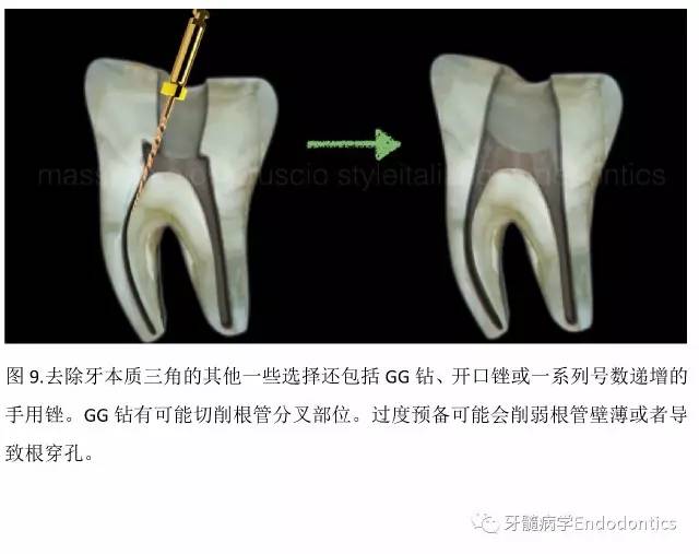 【牙醫學堂】根管冠部預敞