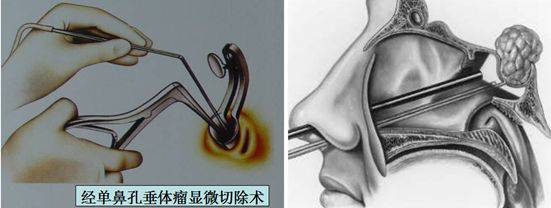 專家提醒市民,腦垂體腺瘤是一種良性腫瘤,早診早治效果好.