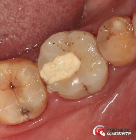 牙髓炎的症状下颚图片