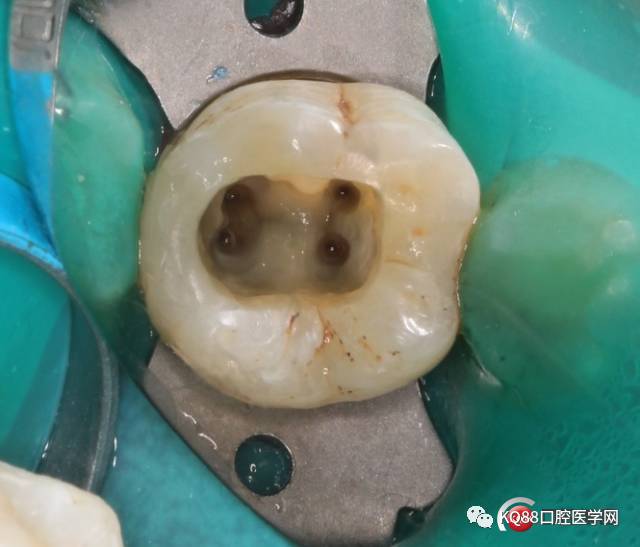一例髓腔根管部分钙化的下颌第一磨牙的治疗